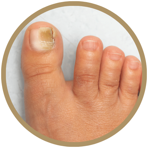 Onicomicosis (hongos en las uñas)