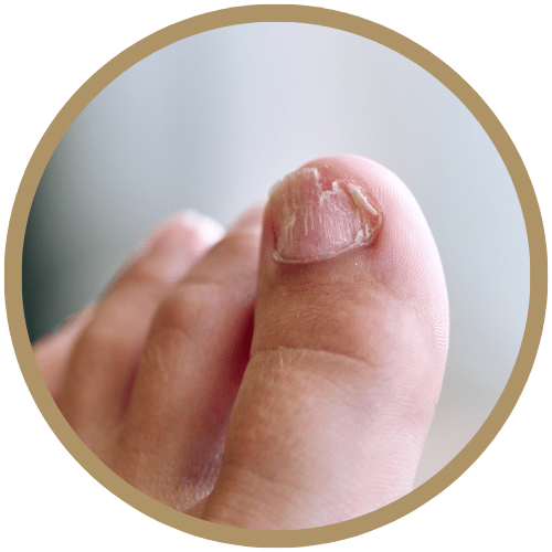 Onicocriptosis (uñas encarnadas)