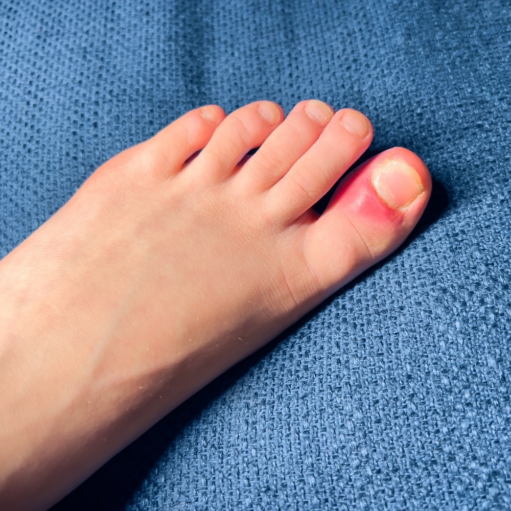Onicocriptosis (Uñas Encarnadas)